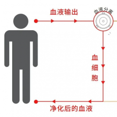 DELP体外血脂吸附疗法